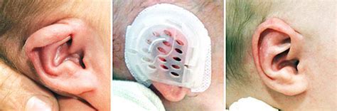 Ear device corrects newborn ear deformities without surgery | News Center | Stanford Medicine