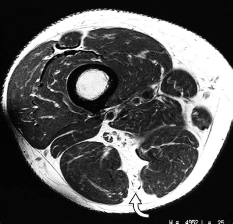 Hamstring Muscle Complex: An Imaging Review | RadioGraphics