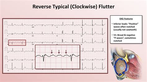 Advanced EKGs - The Subtypes of Atrial Flutter (typical vs. reverse typical vs. atypical) - YouTube