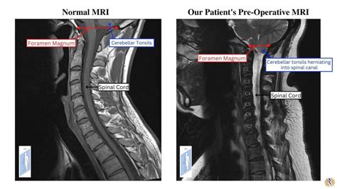 Chiari Malformation - Ilyas Munshi, M.D.