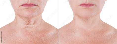 Skin rejuvenation on the neck, before after anti aging concept, wrinkle ...