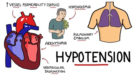 Causes of Hypotension - What causes Low Blood Pressure? (with Signs and ...