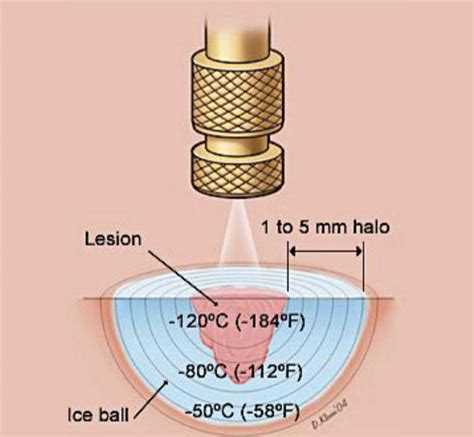 Cryotherapy in Singapore | Assurance Skin Clinic