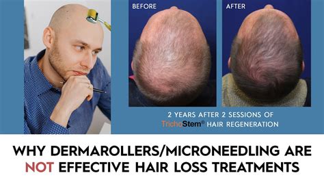 37+ Prp Microneedling Hair Before And After - GermanManoor