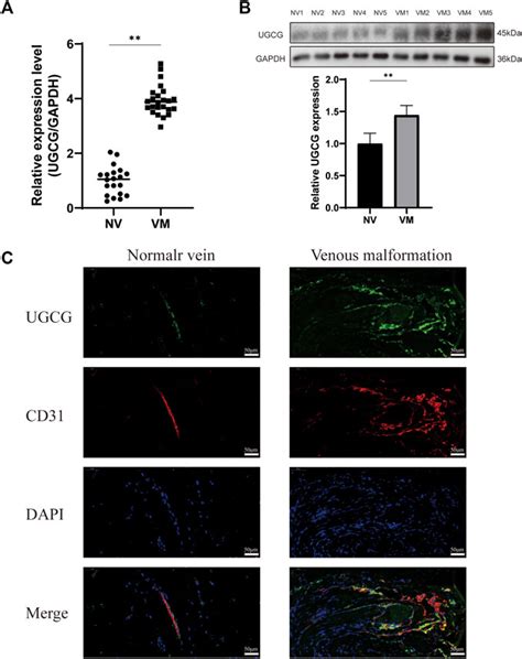 Frontiers | Role of UDP-glucose ceramide glucosyltransferase in venous malformation