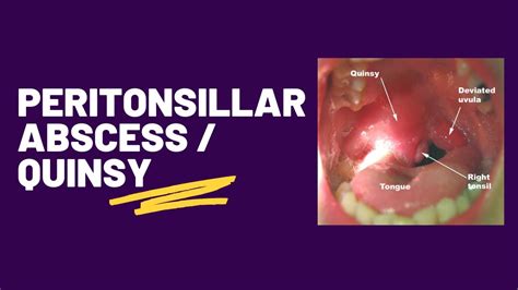 Peritonsillar abscess | Quinsy - YouTube