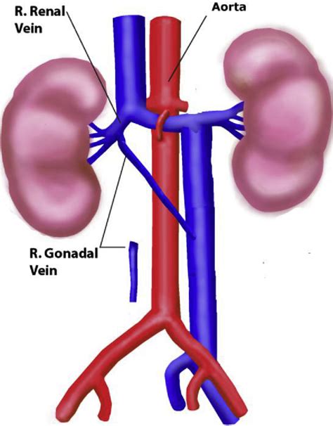 Figure 3 from Right gonadal vein transposition for the treatment of anterior nutcracker syndrome ...