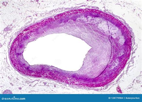 Coronary Atherosclerosis, Light Micrograph Stock Photo - Image of pathology, microscopy: 128779984