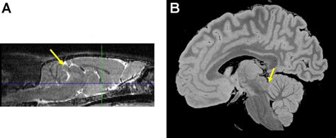 Frontiers | The Inferior Colliculus in Alcoholism and Beyond