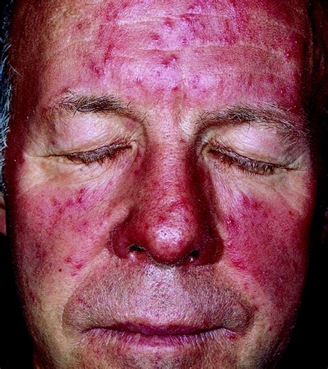 Rosacea erythema and few pustules affecting the face. Reprinted with... | Download Scientific ...