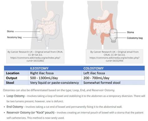 Colostomy vs Ileostomy - MEDizzy