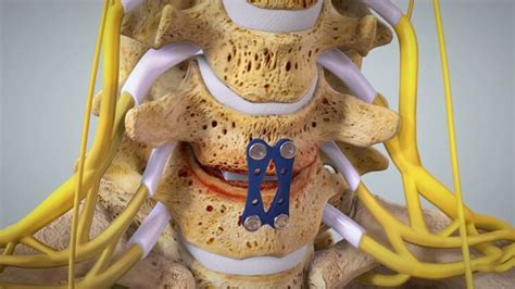 Cervical Spine Surgery Success Rate - Should You Opt for It?