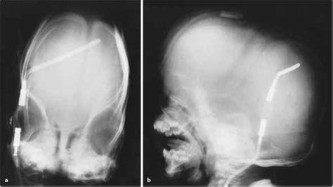 Orbital Hypertelorism - Syndrome Omim - RR School Of Nursing