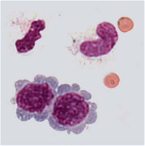 Pathological CSF Cell Findings in Primary and Metastatic CNS Tumors ...