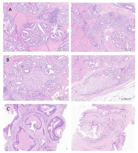 Selected histological images of patients with cribriform or intraductal... | Download High ...