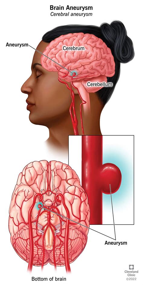 Brain Aneurysm: What It Is, Causes, Symptoms & Treatment