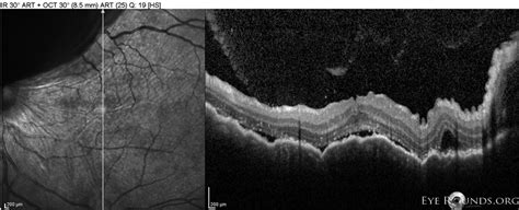 Atlas Entry - Mantle cell lymphoma with choroidal metastasis