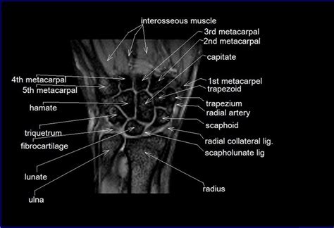 MRI wrist coronal anatomy | wrist tendon and ligaments anatomy | cross sectional anatomy ...