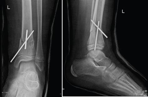 Distal Tibia Fracture