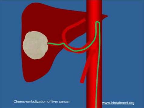 ChemoEmbolization (TACE) for Liver Cancer - YouTube