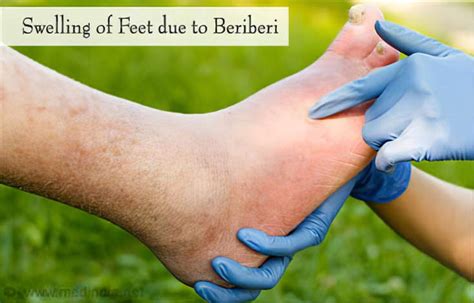 Beriberi Disease - Causes, Risk Factors, Symptoms, Diagnosis, Treatment ...