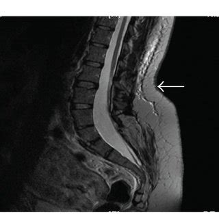 Sagittal view of the patient's MRI scan with spinal cord. The arrow ...