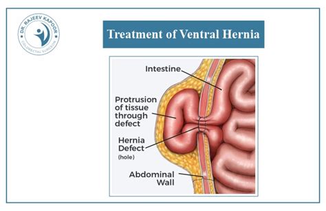 Treatment of Ventral Hernia: Exploring the Latest Techniques