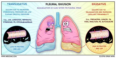 Pleural Effusions: Transudate vs. Exudate | Medcomic