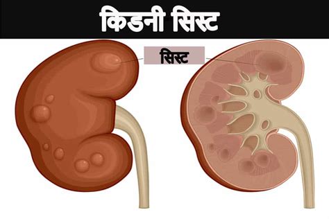 किडनी सिस्ट: प्रकार, कारण, लक्षण, जांच, इलाज सरल भाषा में