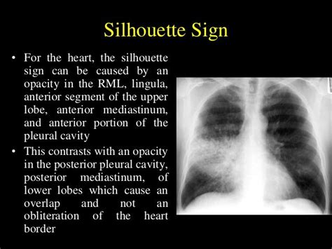 Helpful radiological signs in cxr25 11-91