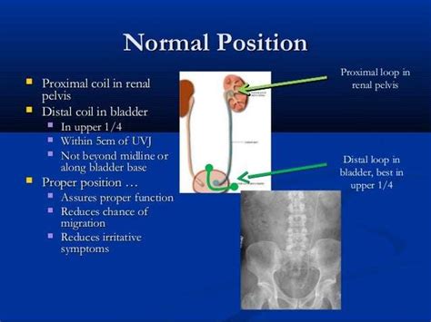 What To Expect After Kidney Stone Removal And Stent Placement ...