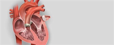 WATCHMAN™ Left Atrial Appendage Closure Device | Warfarin Therapy Alternative - Boston Scientific