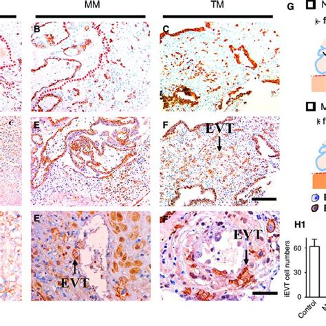 Extravillous trophoblasts (EVTs) shallowly invade in missed (MM) and... | Download Scientific ...