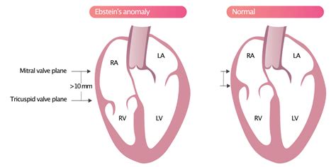 Tricuspid regurgitation (TR/TI) - Echocardiography, diagnosis, causes, management