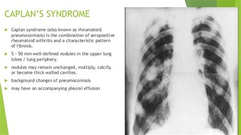 Caplan syndrome,what to know?