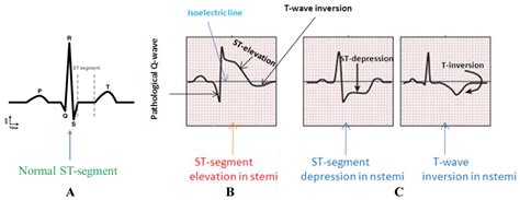 NSTEMI | Myocardial Infarction | Cardiology | Geeky Medics