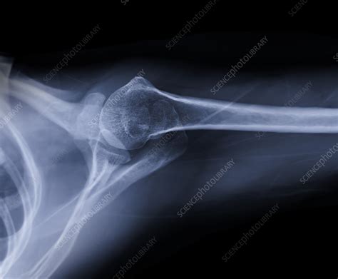 Fractured shoulder, X-ray - Stock Image - F037/5145 - Science Photo Library