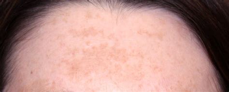 Skin Brown Spot Treatments | Body & Face, Murfreesboro, TN