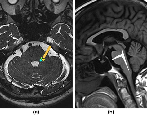 Radiology Anatomy Images Trigeminal Nerve Mri Anatomy | Images and Photos finder