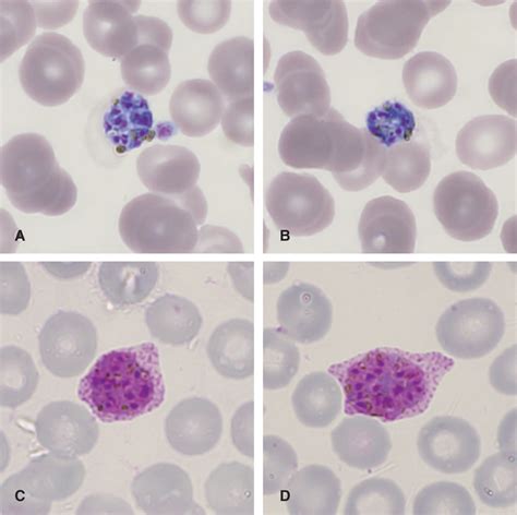Case Report: Diagnostic Challenges in the Detection of a Mixed Plasmodium vivax/ovale Infection ...
