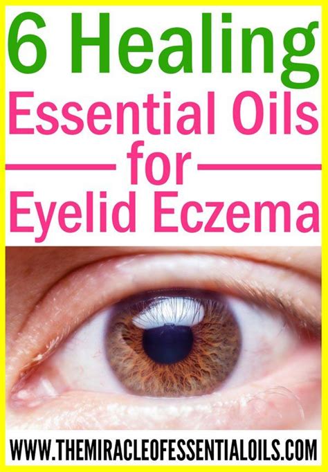 6 Essential Oils for Eczema on Eyelids (plus Healing Cream Recipe ...