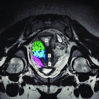 Longitudinal axis of a normal pelvis with a retroverted uterus ...