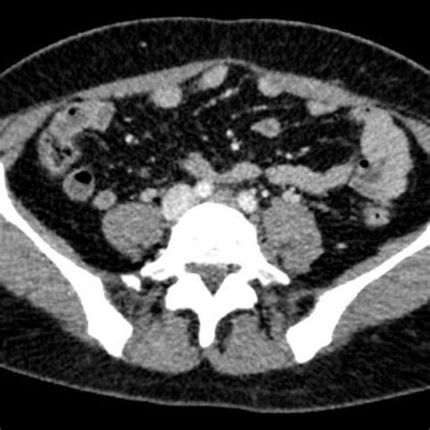 A Case Report of May-Thurner Syndrome Identified on Abdominal ...