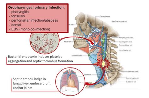 emDOCs.net – Emergency Medicine EducationEM in 5: Lemierre’s Syndrome - emDOCs.net - Emergency ...