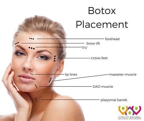 Diagram Botox Lip Flip Injection Points