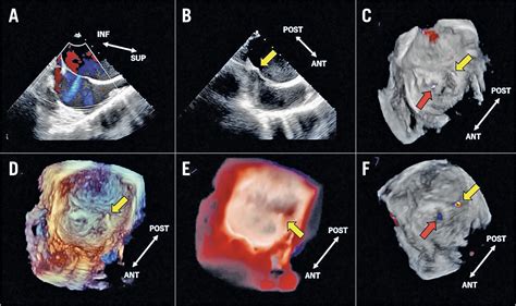 New three-dimensional rendering image of transoesophageal echocardiography for second ...