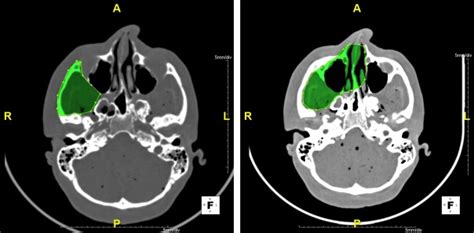 Axial CT bone windows- Examples of using the segmented volumetric ...