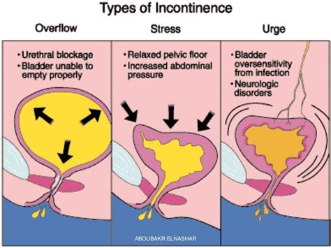 INCONTINENCE OF URINE