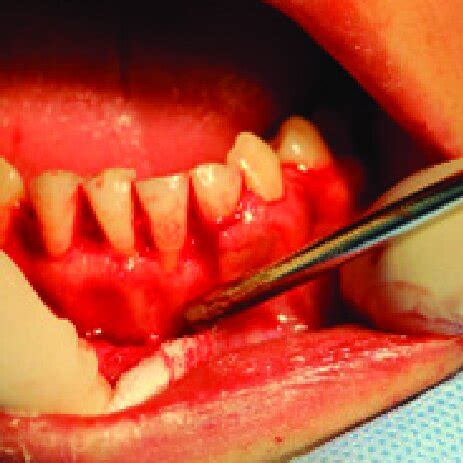 Incisional biopsy procedure. | Download Scientific Diagram