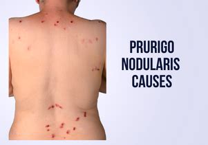 Prurigo Nodularis Causes - Contactmuhammadhassaan - Medium